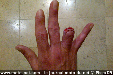 Hopkins amputé de deux phalanges à la main droite